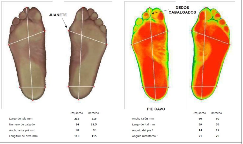 pie pronador Archivos Frescopodologia